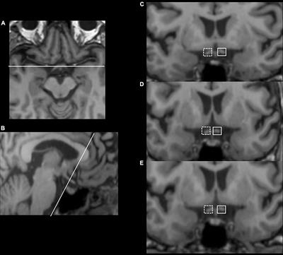 Alterations of optic tract and retinal structure in patients after thalamic stroke